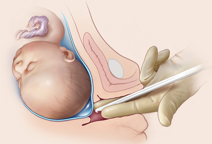 Labor Induction 101: What It Means, When It’s Needed, And What To Expect